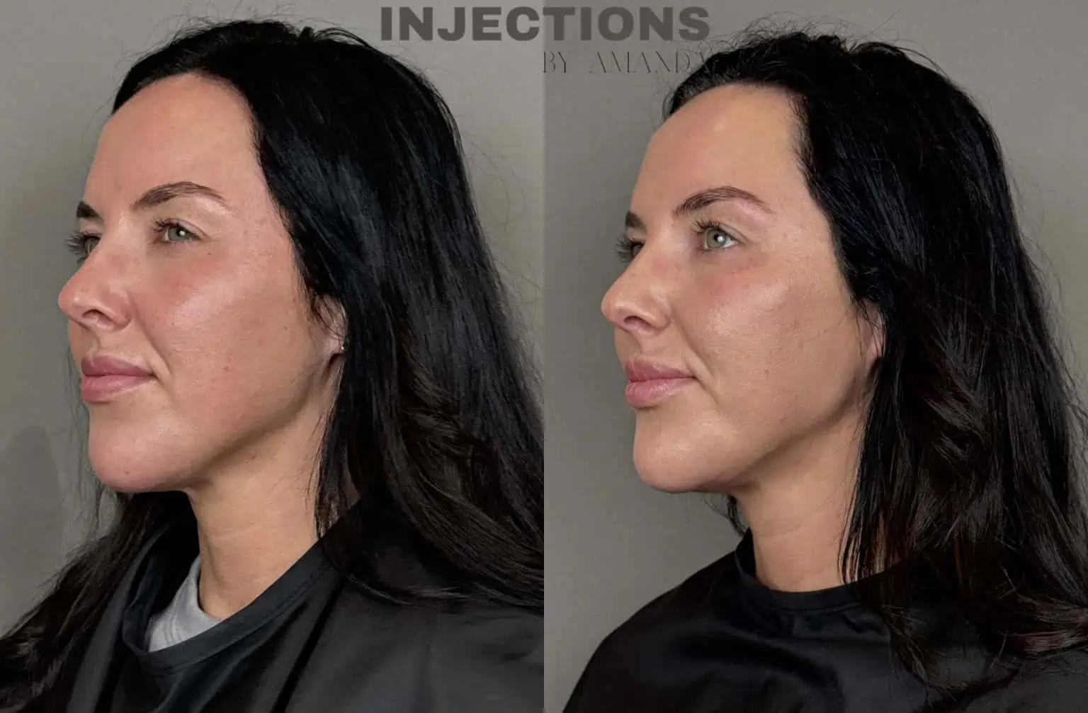 Facial Harmony Trio Before and After Images - 34 Facial Harmony Trio (2)