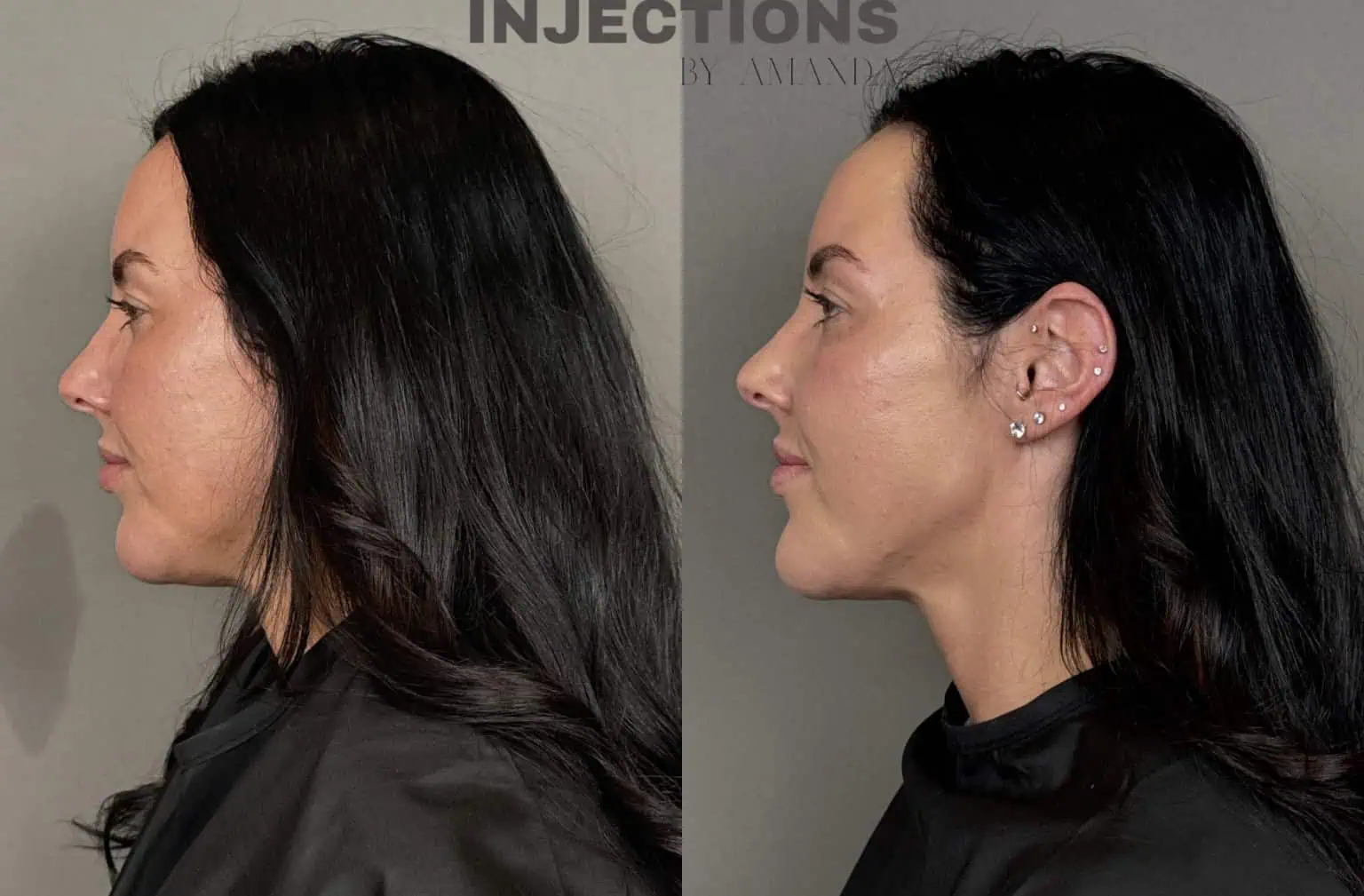 Facial Harmony Trio Before and After Images - 32 Facial Harmony Trio (3)