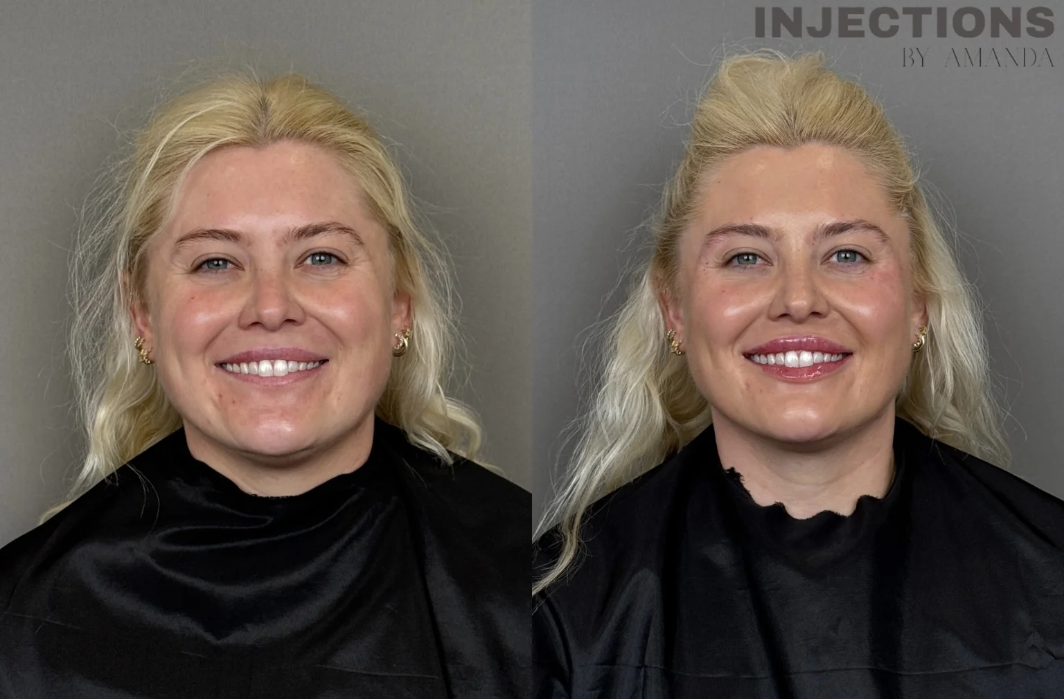 Facial Harmony Trio Before and After Images - 1 Facial Harmony Trio1