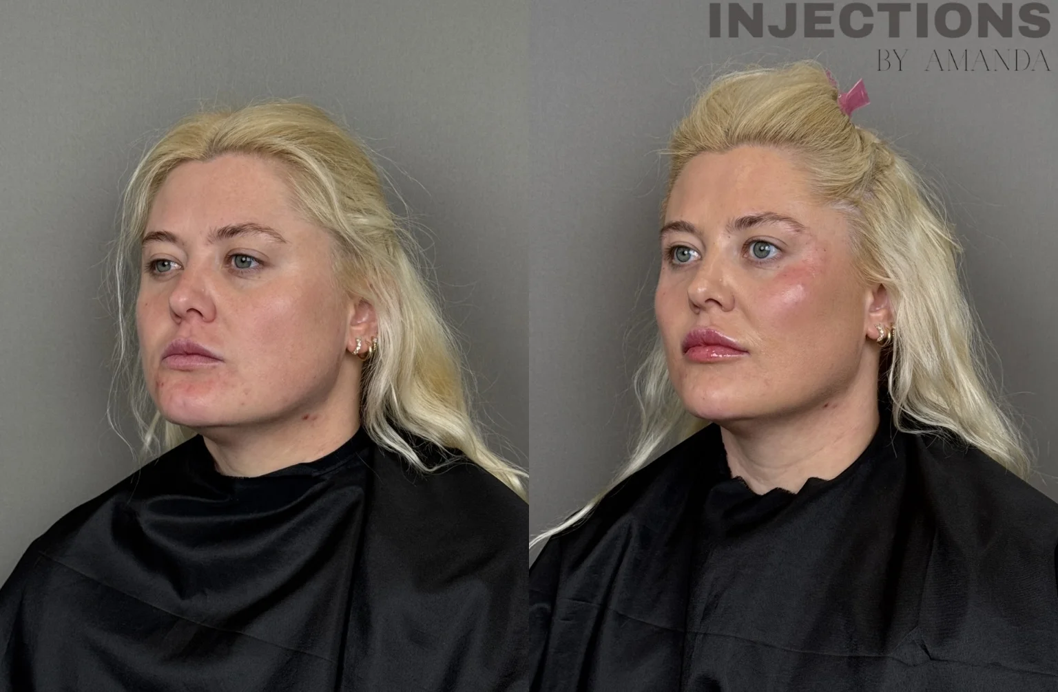 Facial Harmony Trio Before and After Images - 2 Facial Harmony Trio2