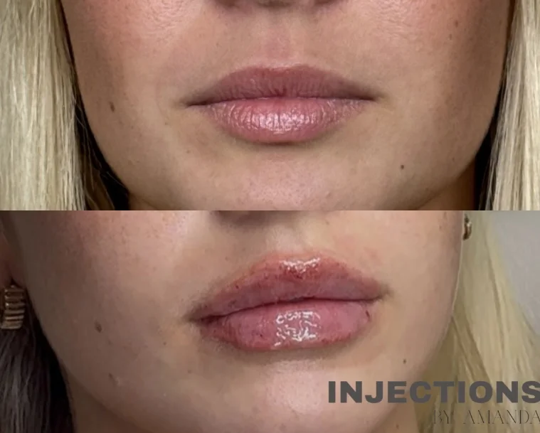 Lip Filler Results - 1 Lip FillerBA
