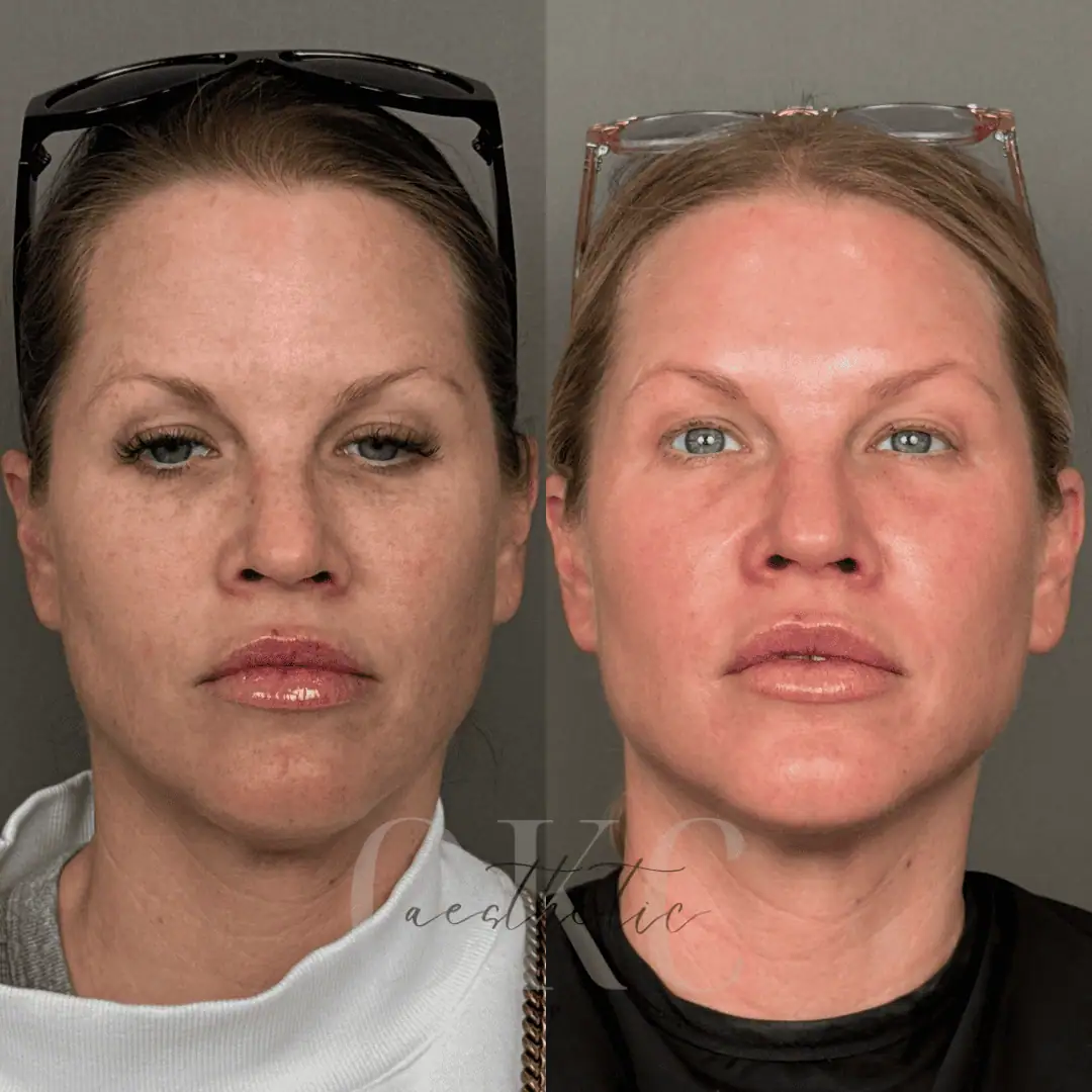 BBL HEROic Before and After Images - 1 BBL HEROic Face + ZO Skin Health