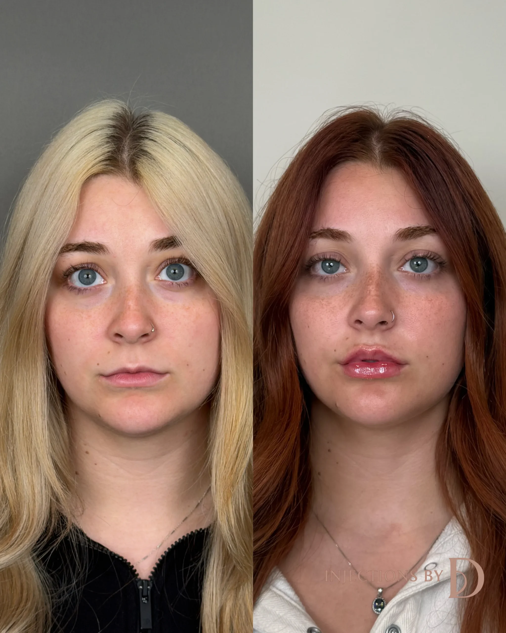 Lip Filler Results - 13 Lip Filler 3