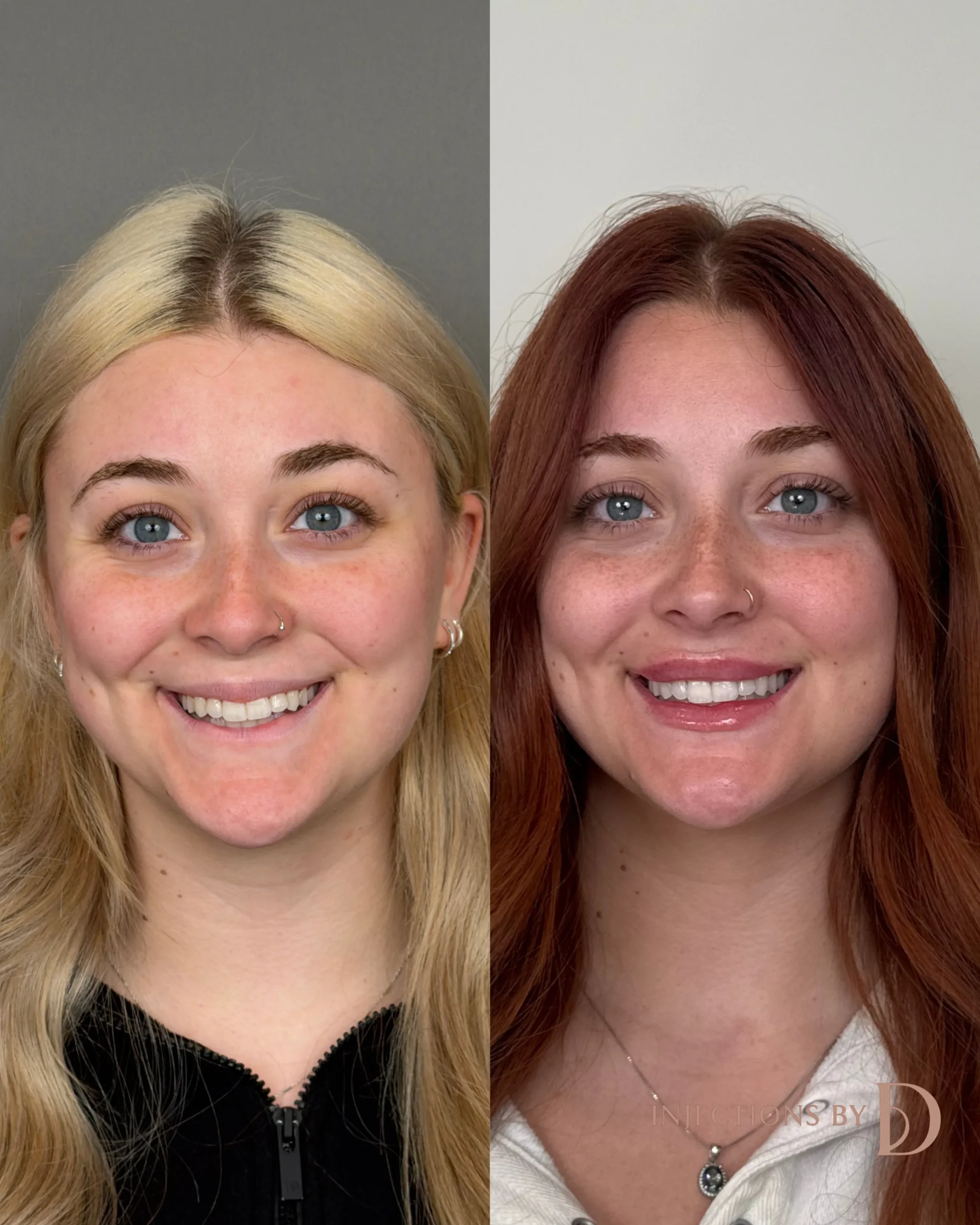 Lip Filler Results - 12 Lip Filler 4