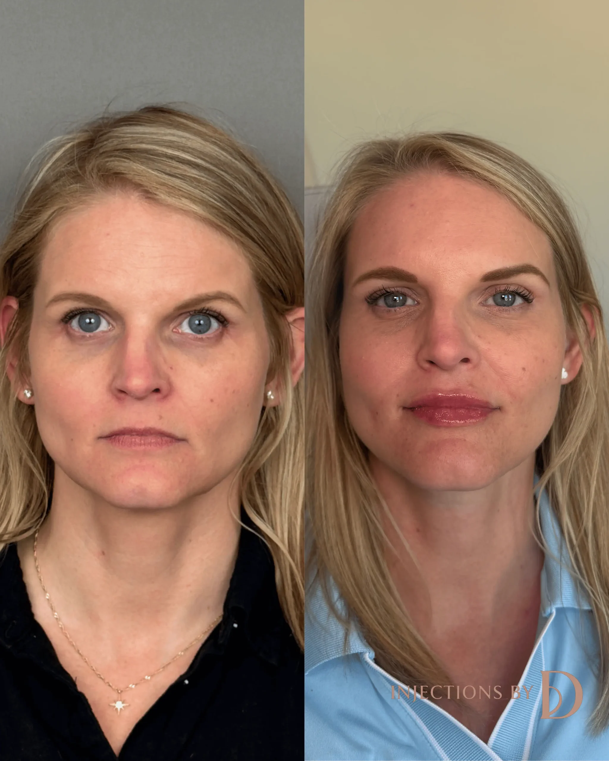 Lip Filler Results - 70 lip filler 1