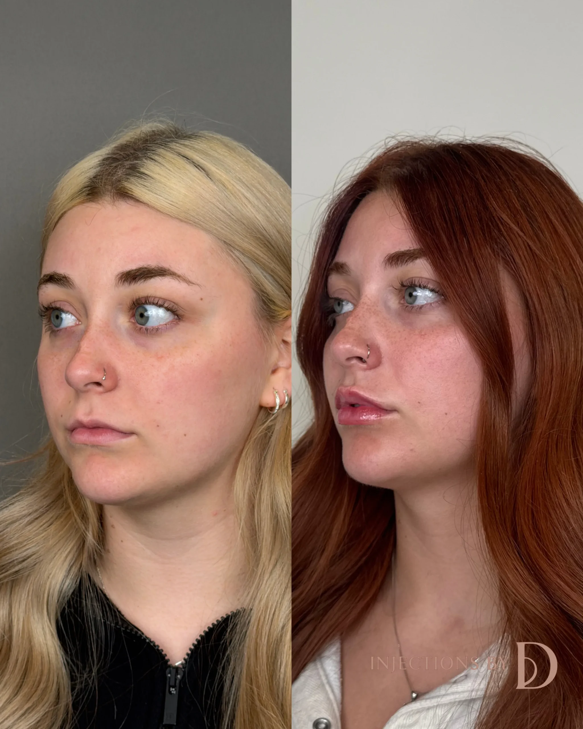Lip Filler Results - 14 lip filler 1