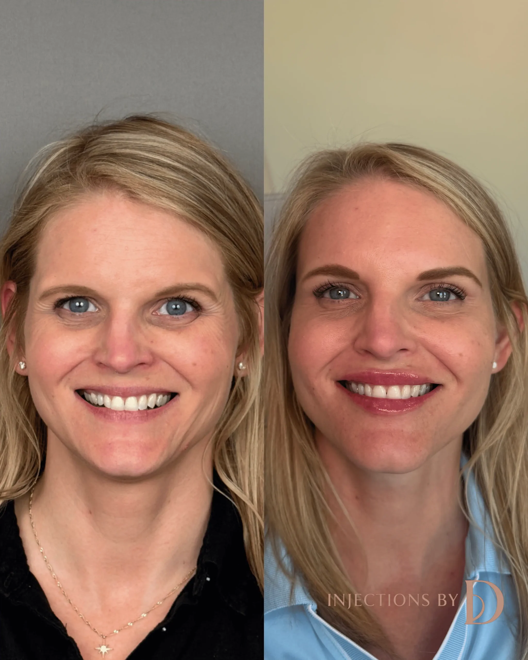 Lip Filler Results - 69 lip filler 2