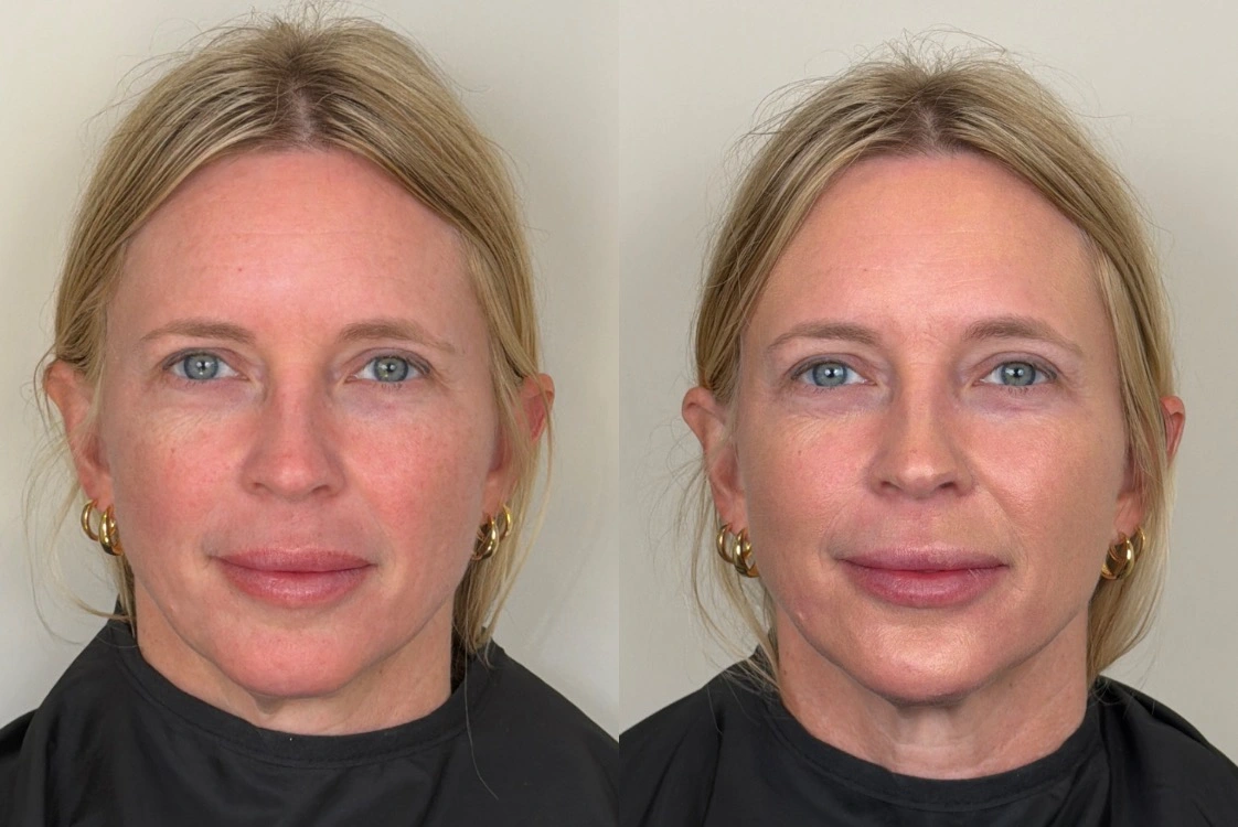 Chin Filler Before and After Images - 25 CHIN FILLER B & A 1