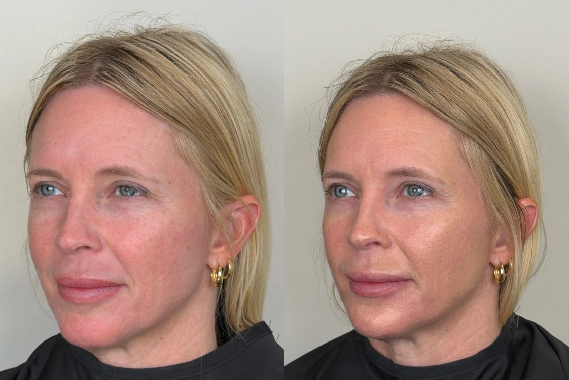 Chin Filler Before and After Images - 24 CHIN FILLER B & A 2