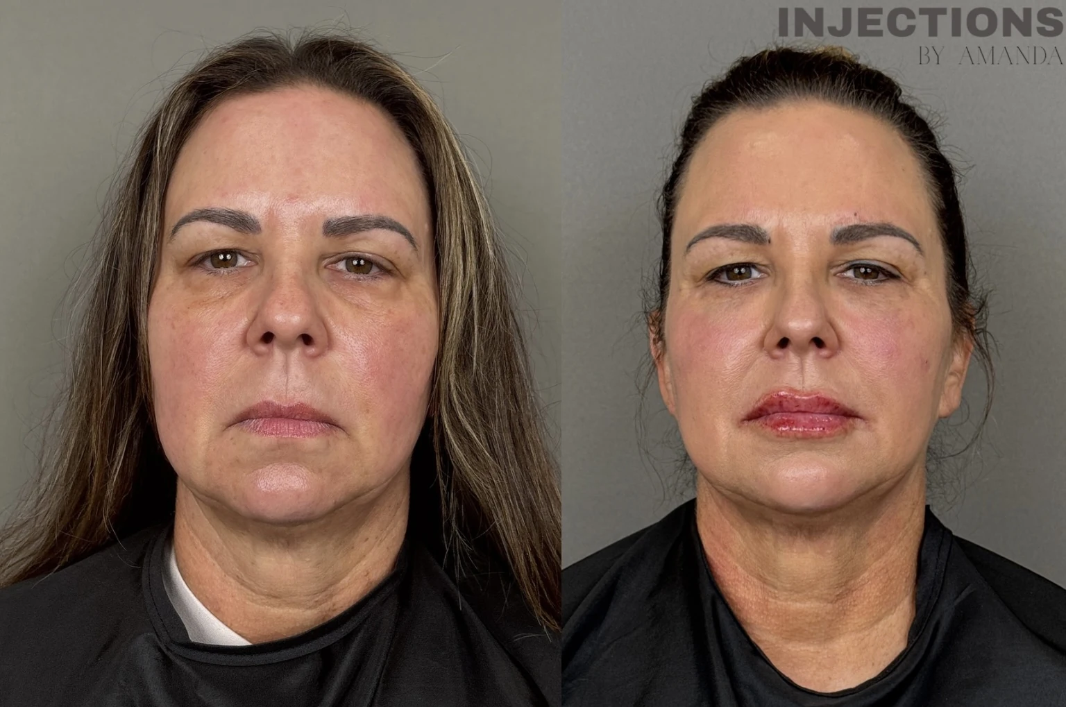 Facial Harmony Trio Before and After Images - 37 Facial-Balancing-Front