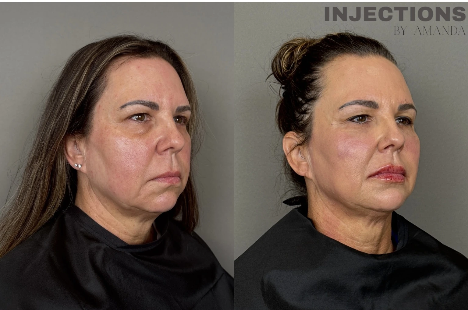 Facial Harmony Trio Before and After Images - 39 Facial-Balancing-Side-View
