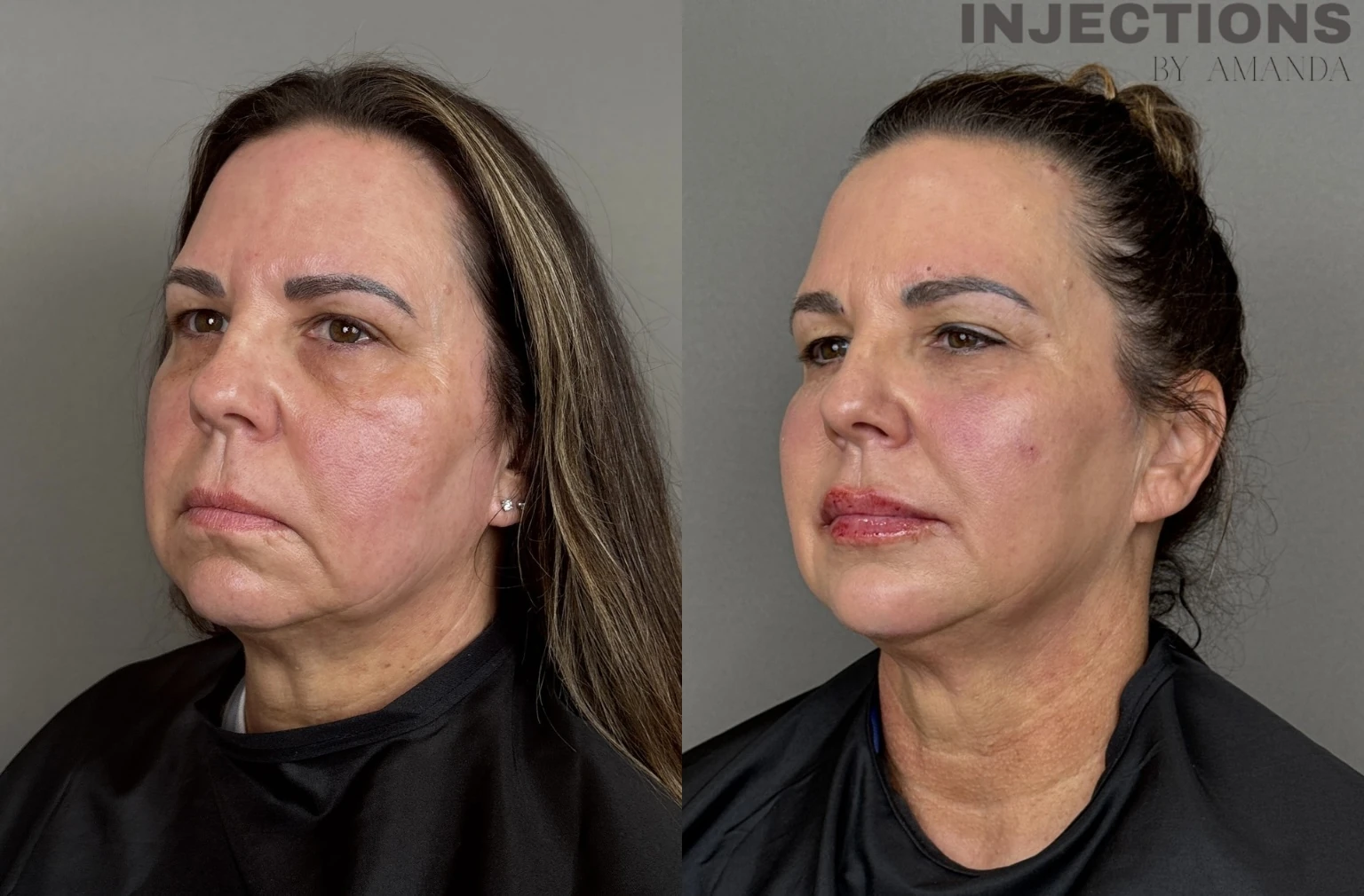 Facial Harmony Trio Before and After Images - 38 Facial-Balancing-Side