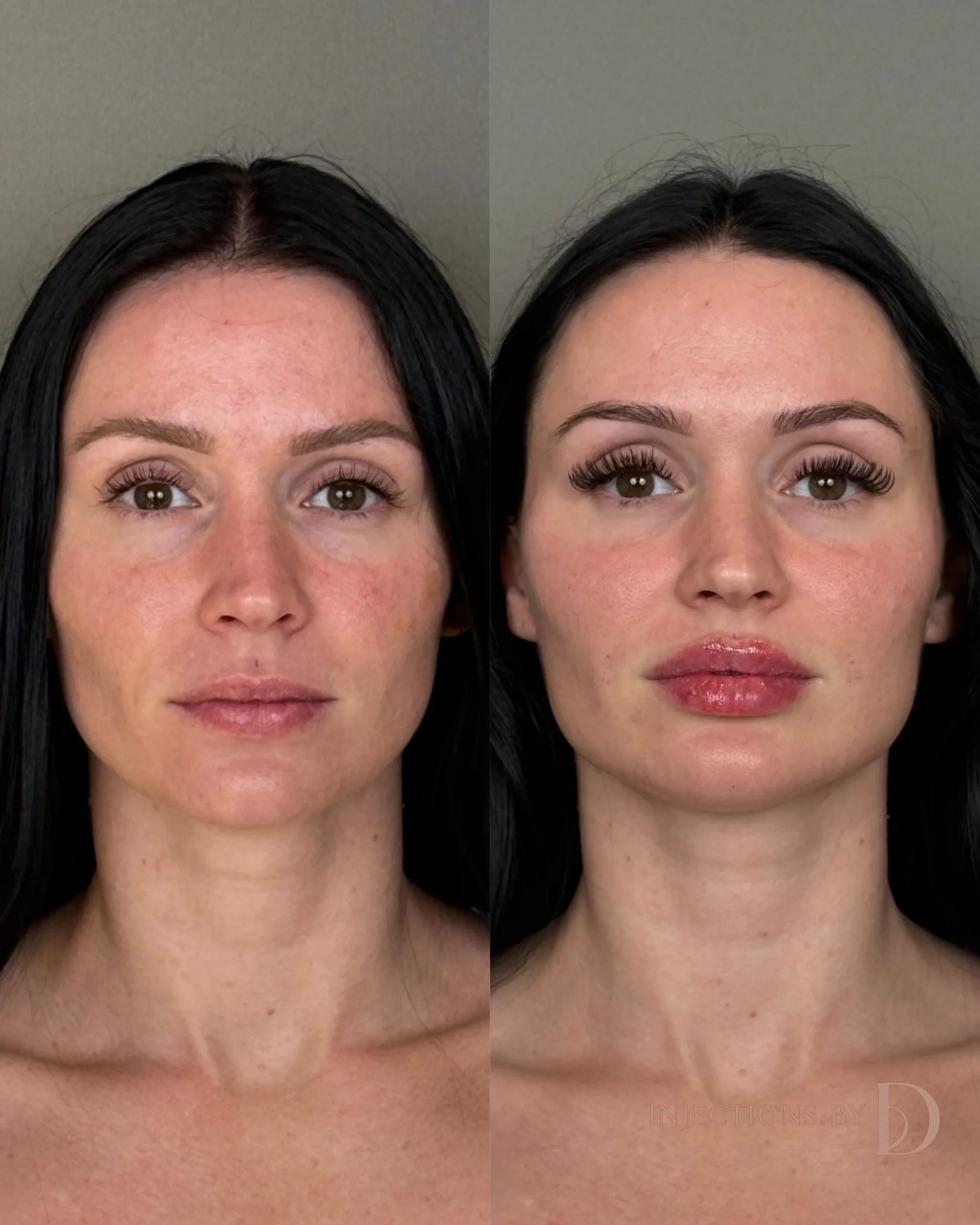 Facial Harmony Trio Before and After Images - 42 Facial Harmony Trio