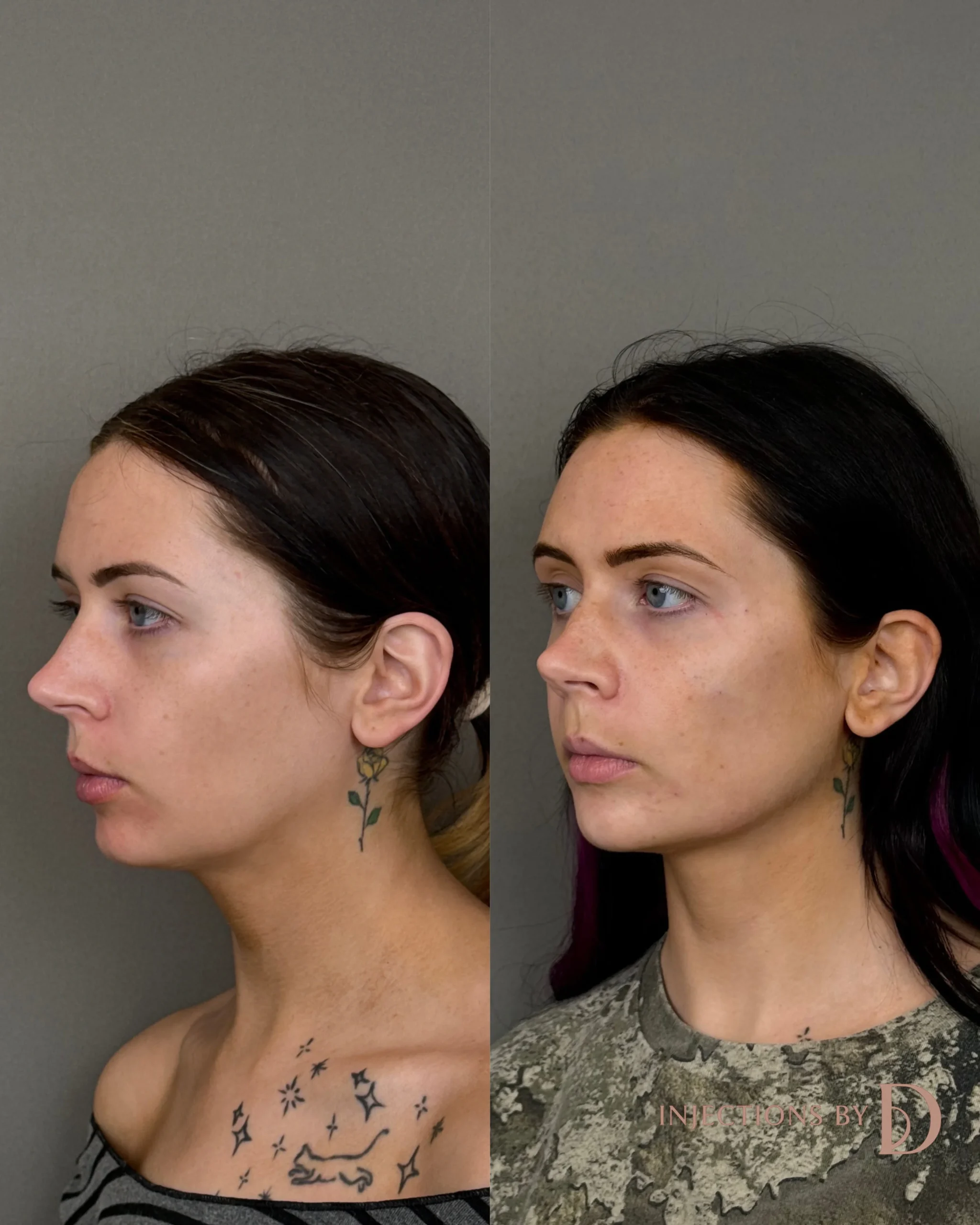 Facial Harmony Trio Before and After Images - 1 Facial Harmony Trio-24-1