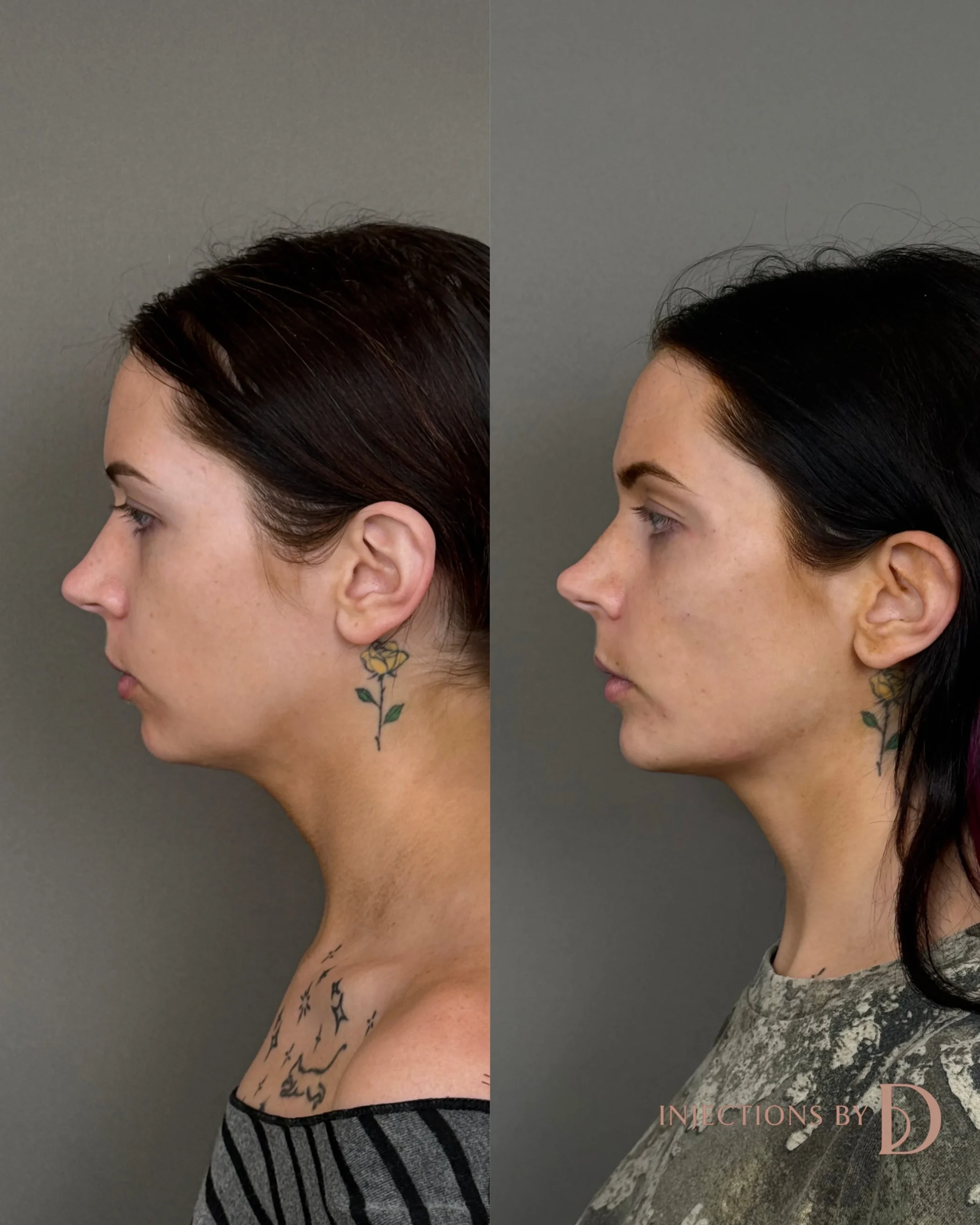 Facial Harmony Trio Before and After Images - 2 Facial Harmony Trio-24-2