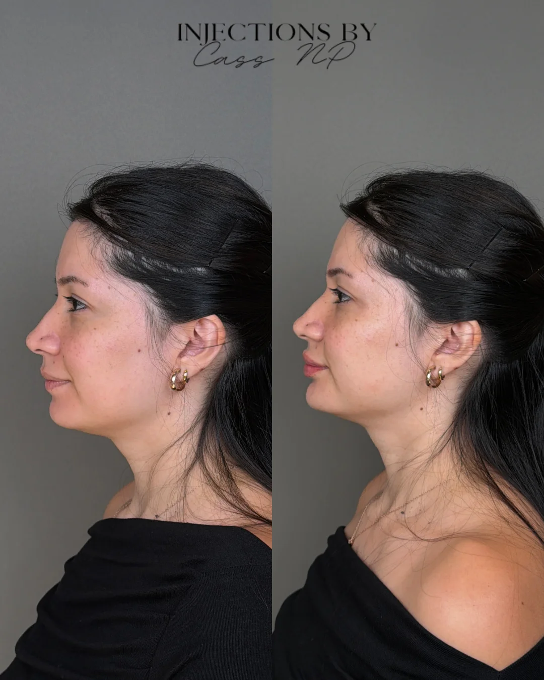 Facial Harmony Trio Before and After Images - 40 Facial Harmony Trio