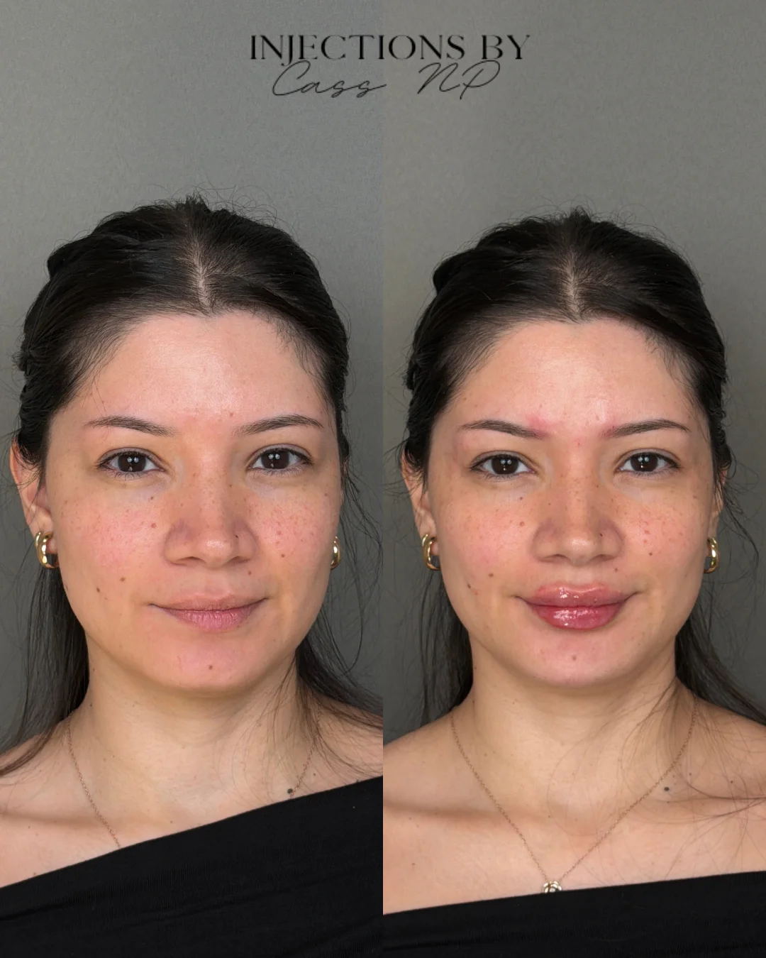 Facial Harmony Trio Before and After Images - 41 Facial Harmony Trio1