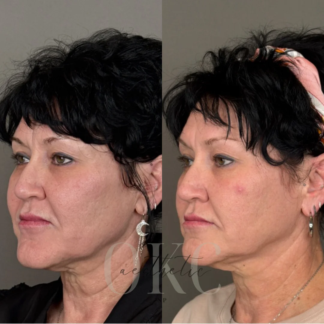 SkinPen Microneedling Before and After Images - 1 Hyperdilute Radiesse® and Skinpen