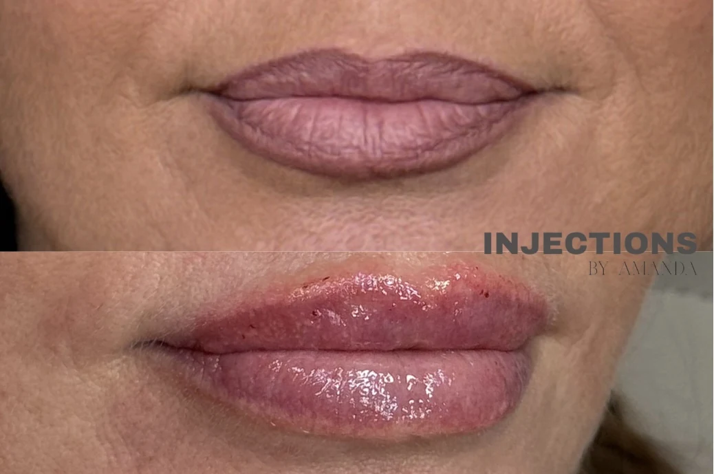 Lip Filler Results - 6 Lip Filler