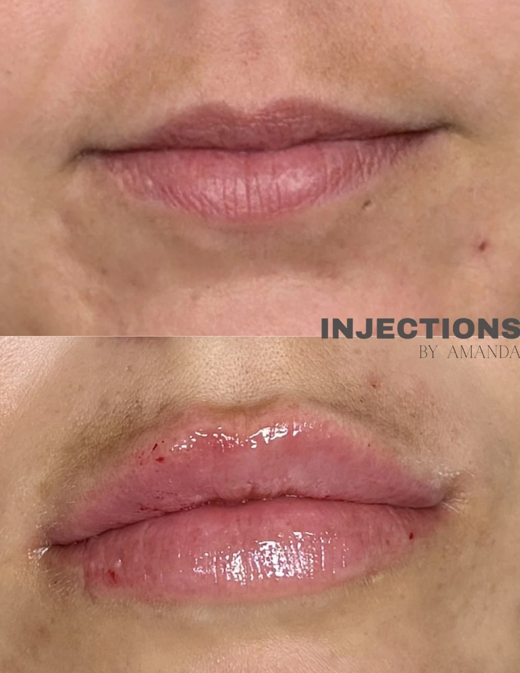 Lip Filler Results - 5 Lip Filler (2)