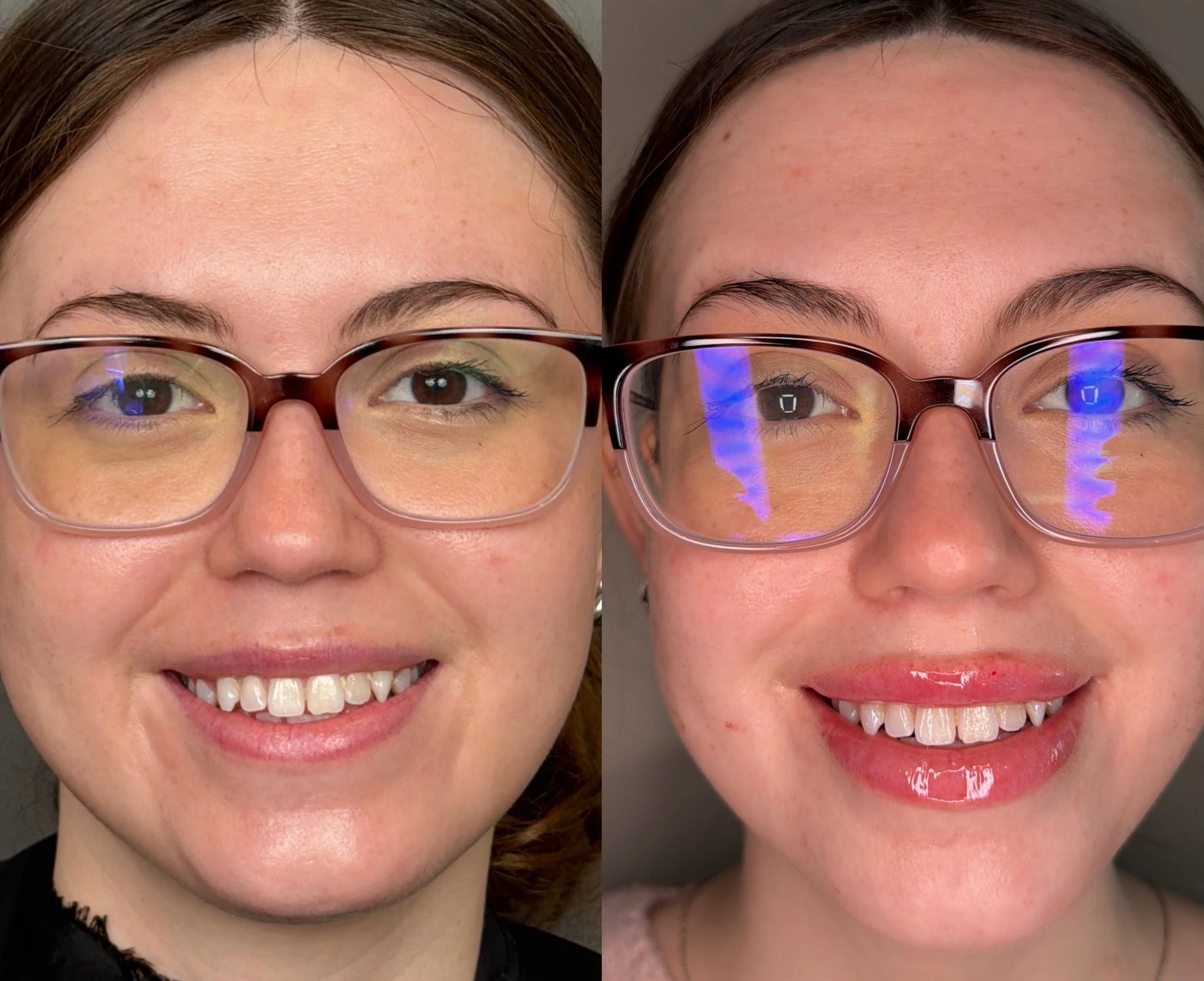 Lip Filler Results - 8 Lip Filler (2)