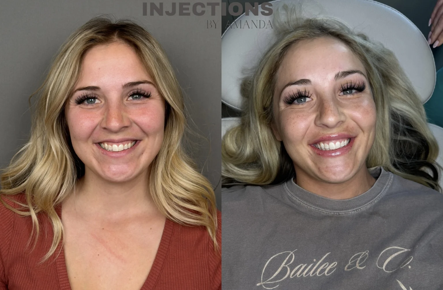 Lip Filler Results - 4 Lip Filler