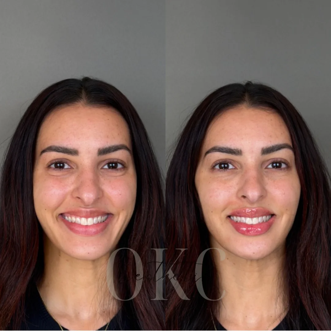 Lip Filler Results - 72 Lip Filler BA