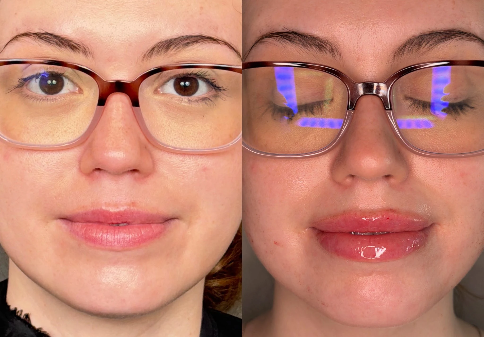 Lip Filler Results - 7 Lip Filler