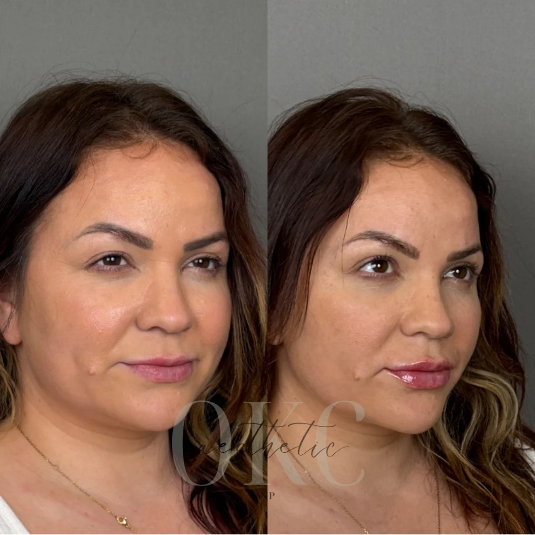 Lip Filler Results - 73 Lip FillerBA