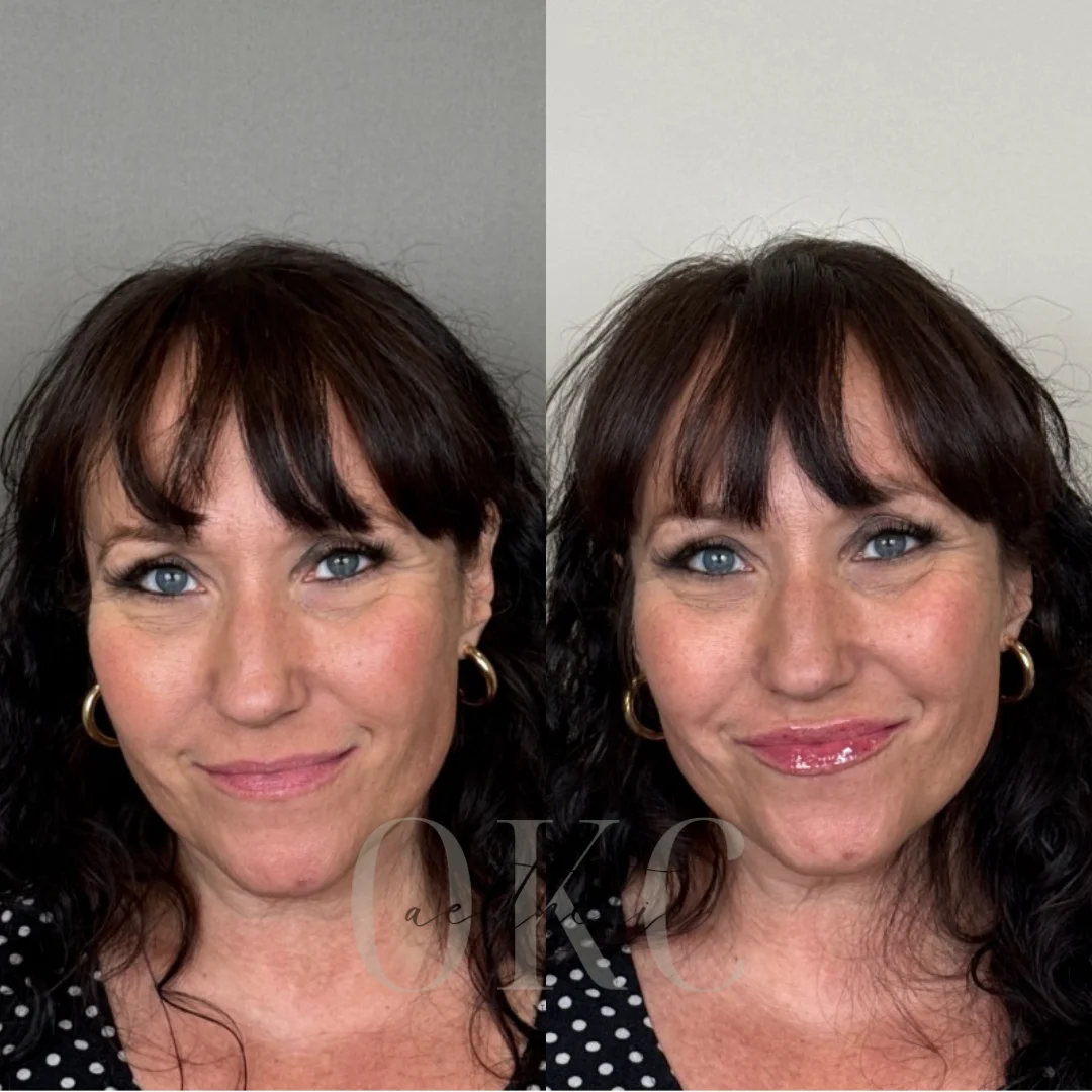 Lip Filler Results - 71 Lip FillerBBAA