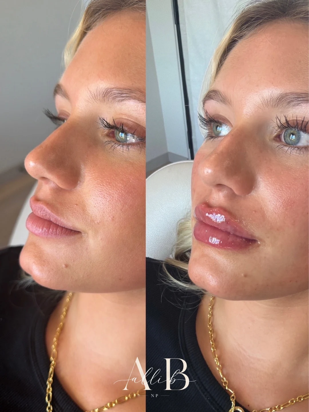 Lip Filler Results - 3 Lip Filler_BA