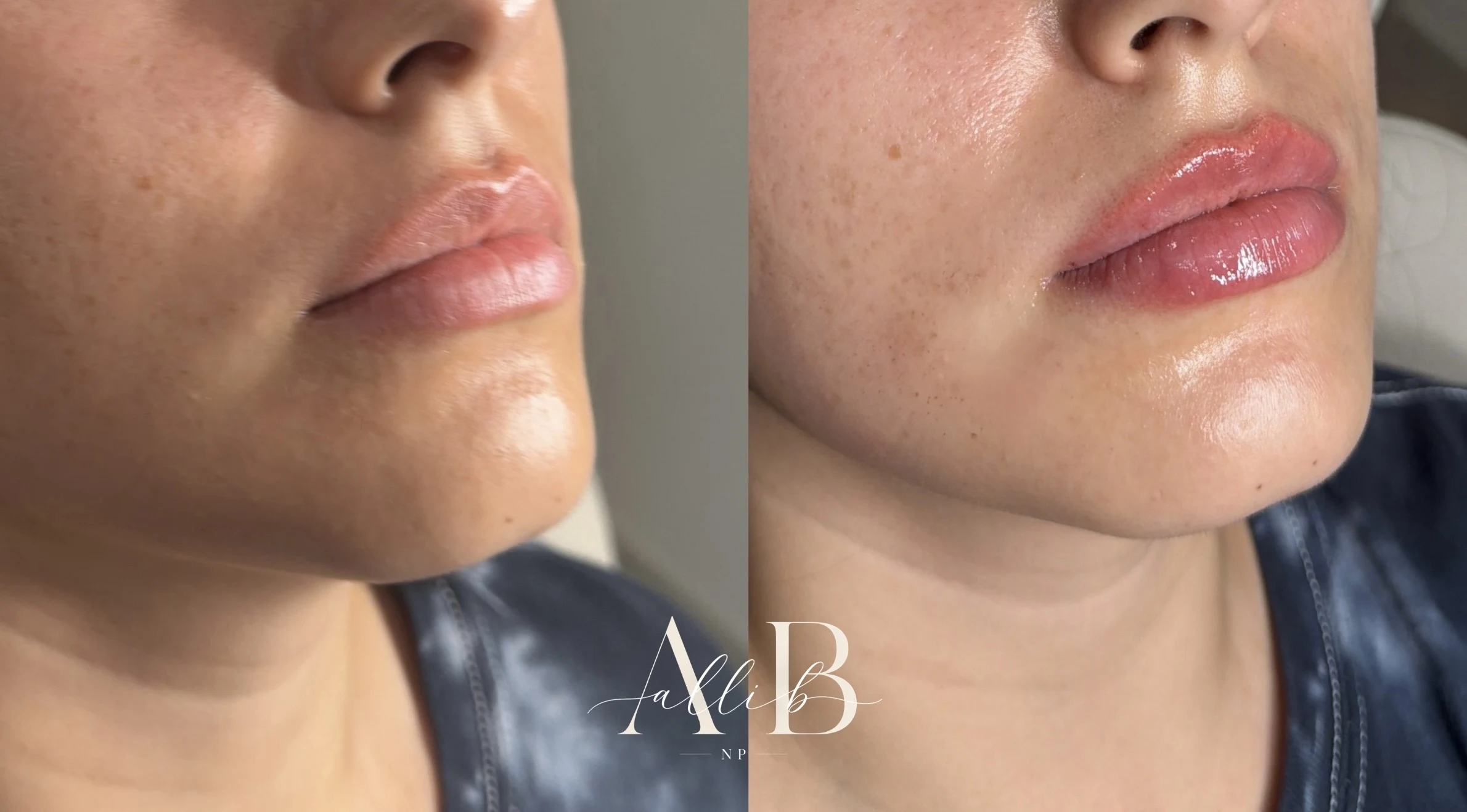 Lip Filler Results - 1 Lip Filler_B_A-1