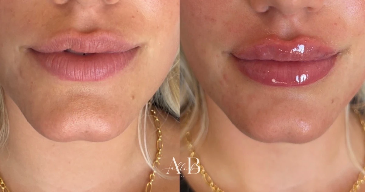 Lip Filler Results - 2 Lip Filler_B_A