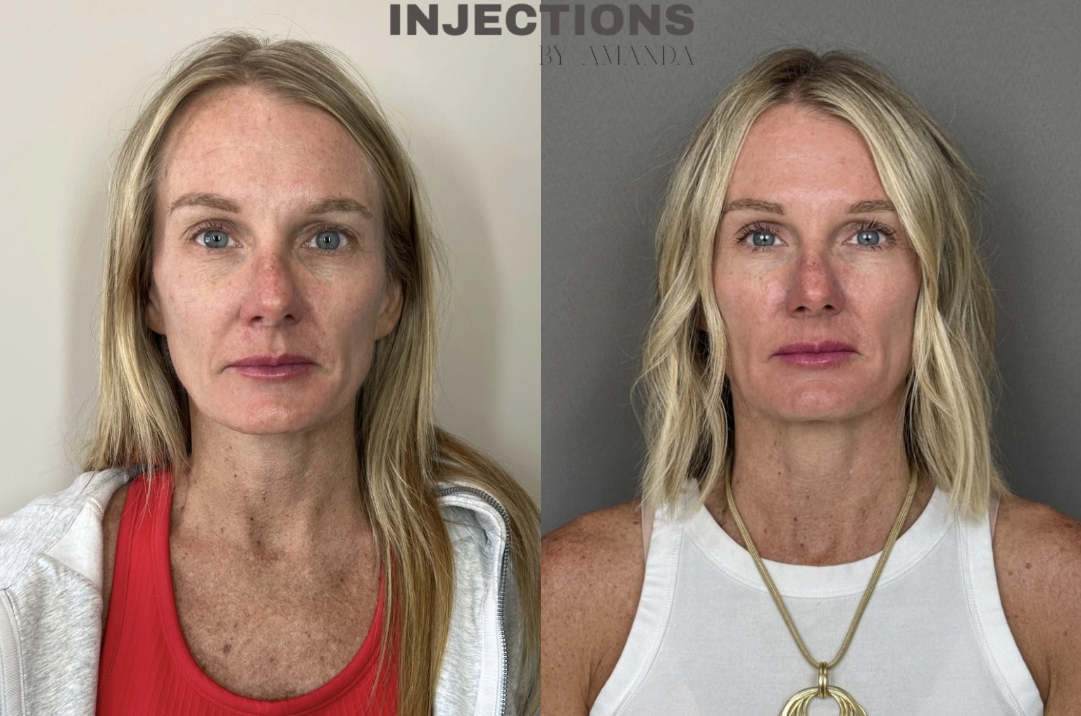 Tox Before and After Images - 30 botox