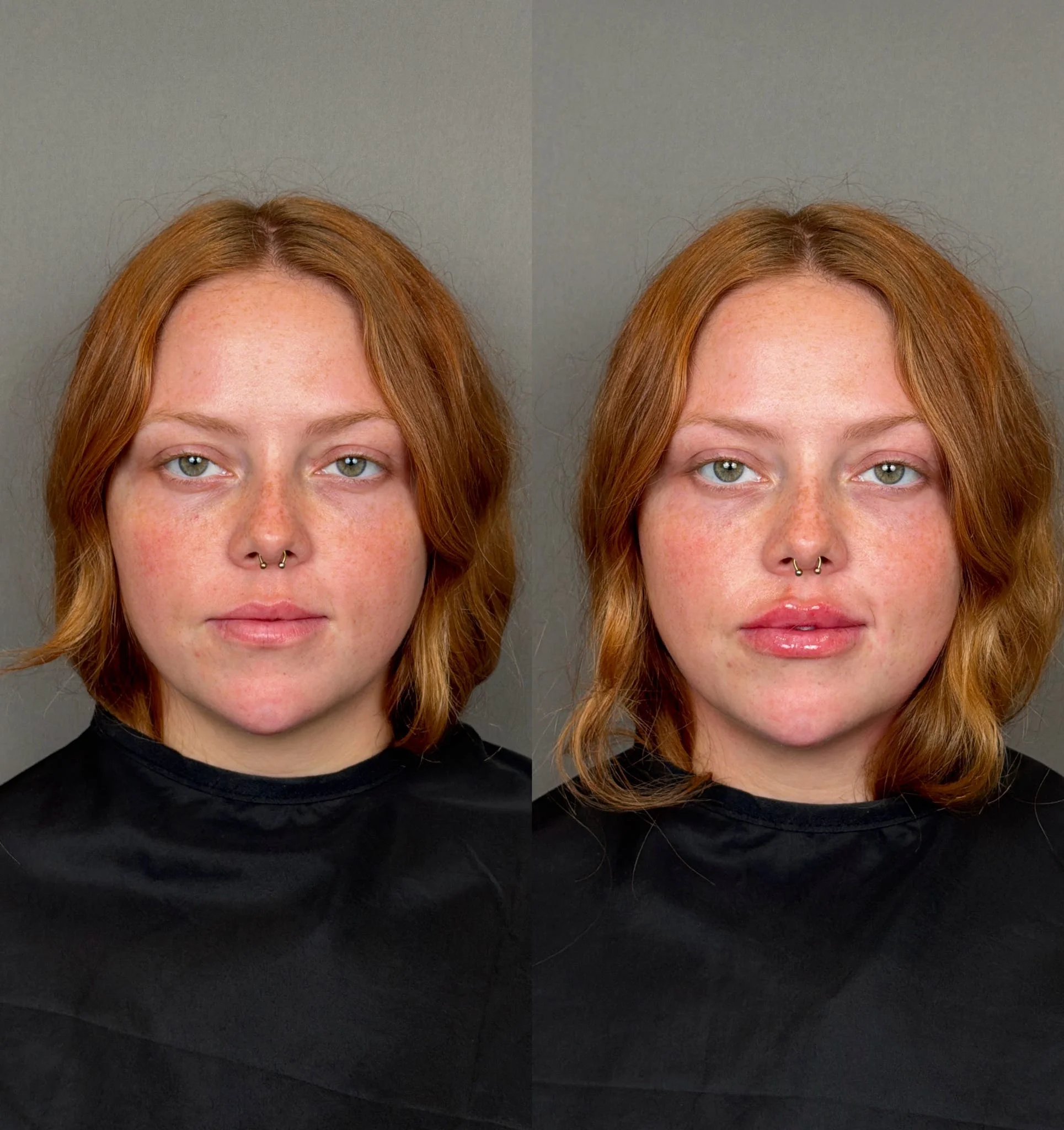Lip Filler Results - 10 lip-filler-64-1