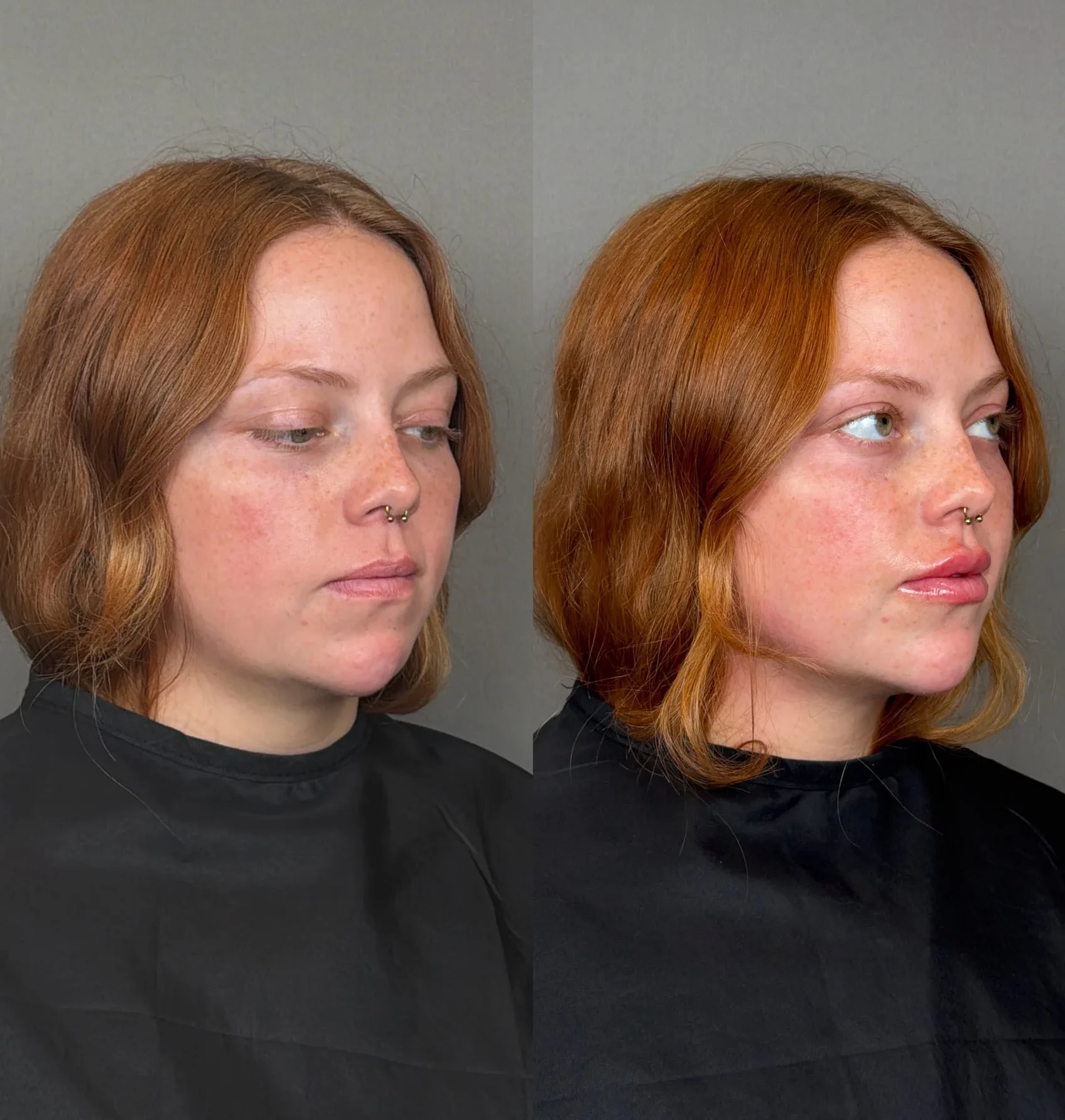 Lip Filler Results - 11 lip-filler-64-2