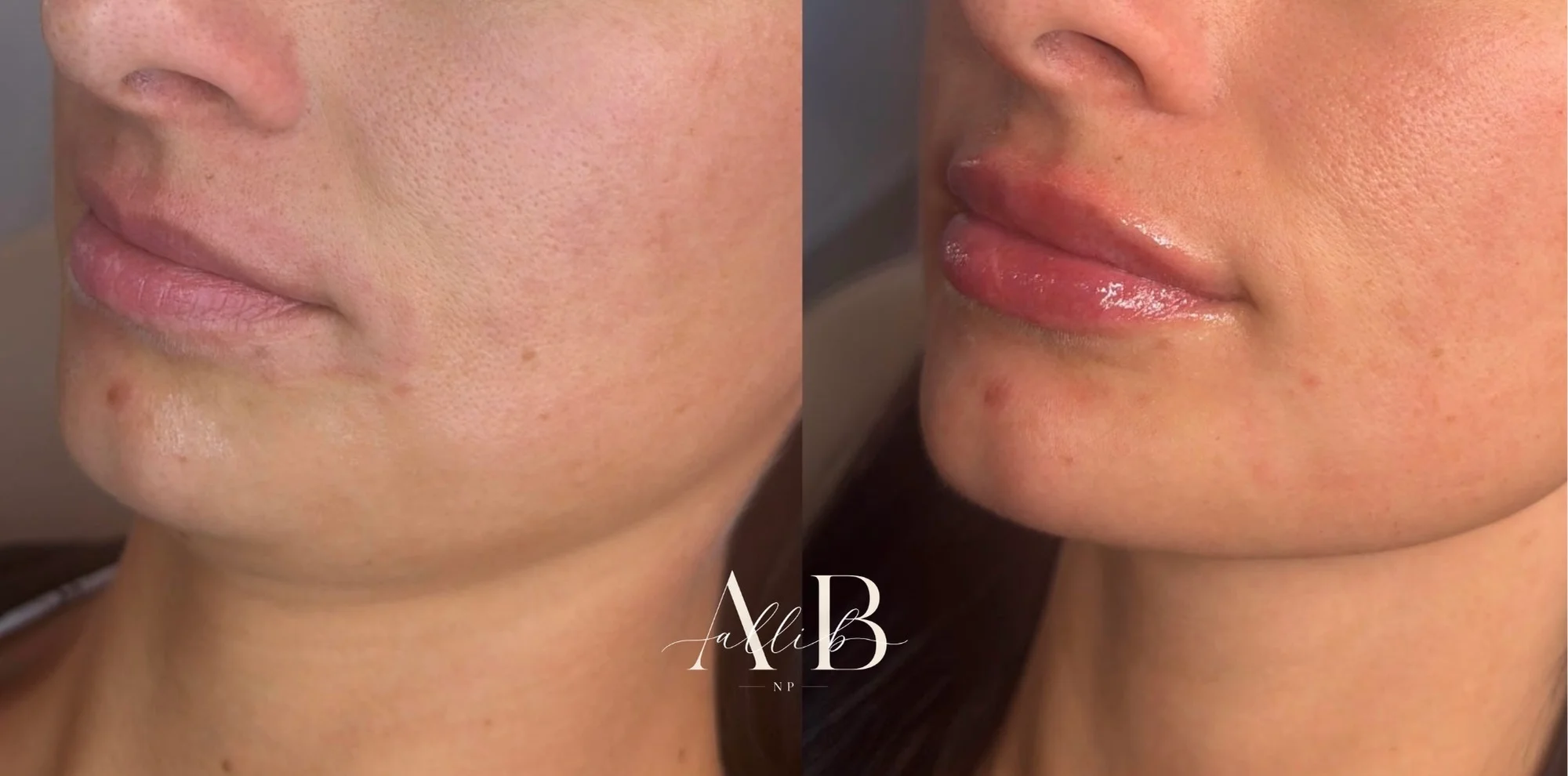 Lip Filler Results - 9 lip-filler-65-1