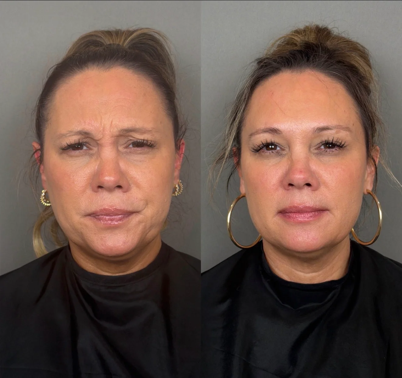 Tox Before and After Images - 29 tox-27-1