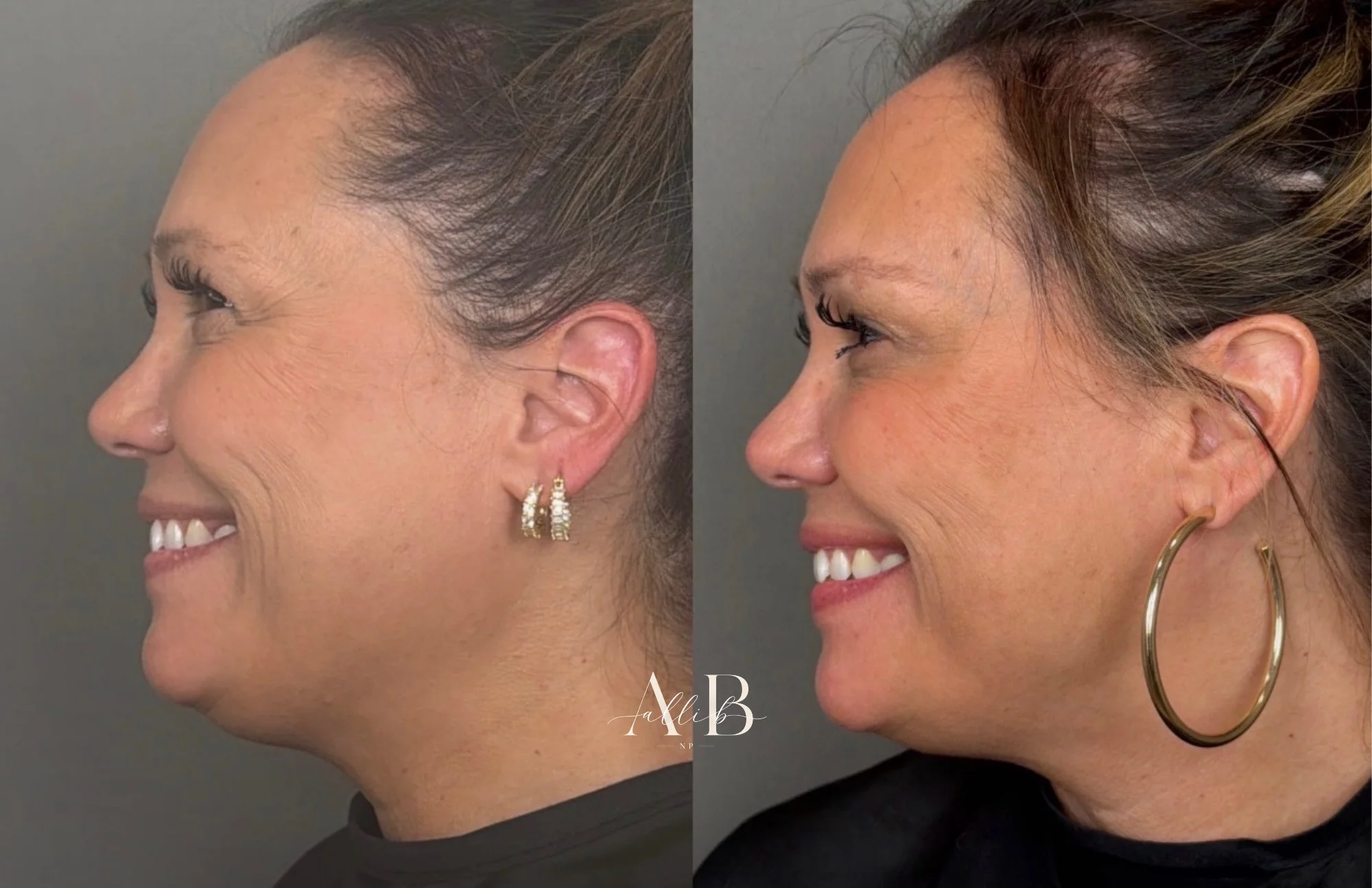 Tox Before and After Images - 28 tox-27-2