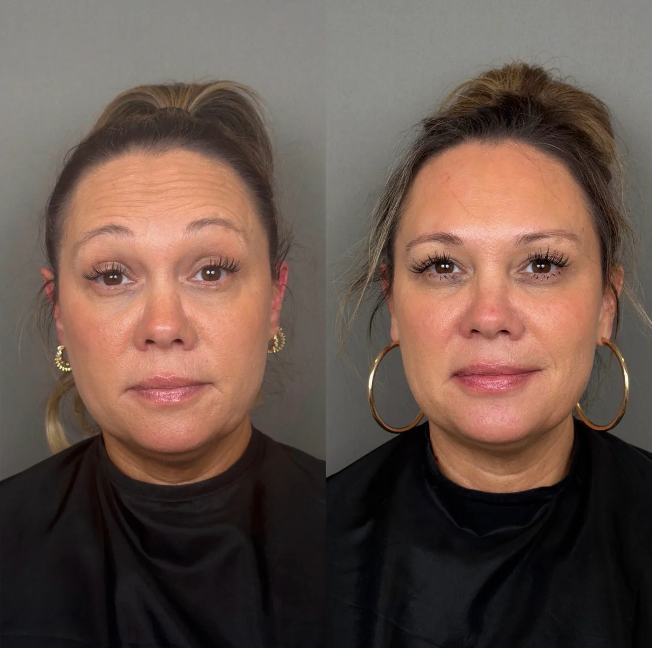 Tox Before and After Images - 27 tox-27-3