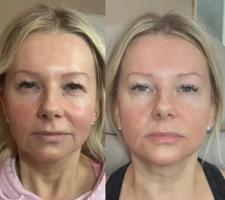 Ariessenence PDGF+Before and after 2