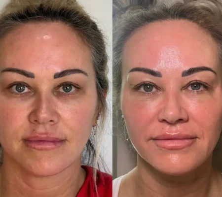 Ariessenence PDGF+Before and after 3