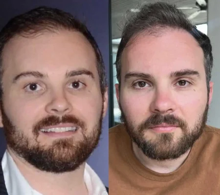 Ariessenence PDGF+Before and after 4