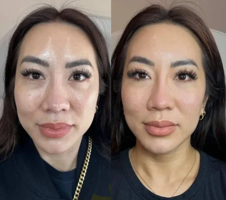 Ariessenence PDGF+Before and after 5