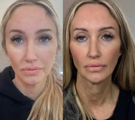 Ariessenence PDGF+Before and after 6