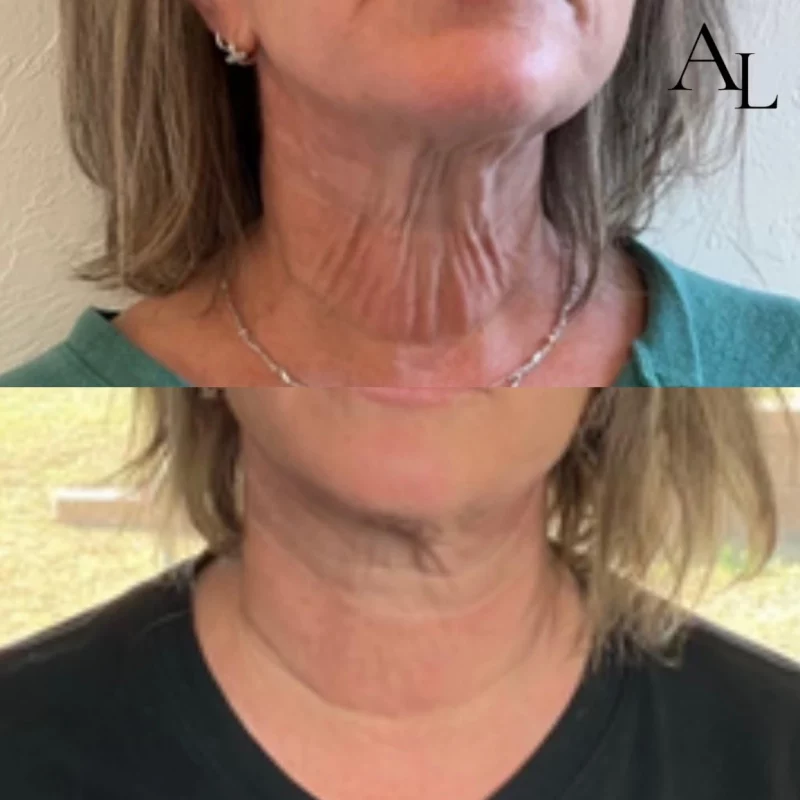 Neck-before-after