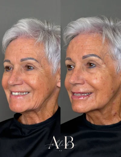 Youthful Essence Before and After Images - 19 RHA Dynamic Volume and Redensity -a