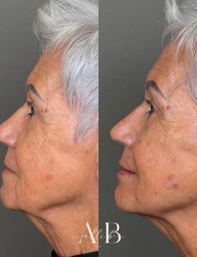 Youthful Essence Before and After Images - 20 RHA Dynamic Volume and Redensity - b