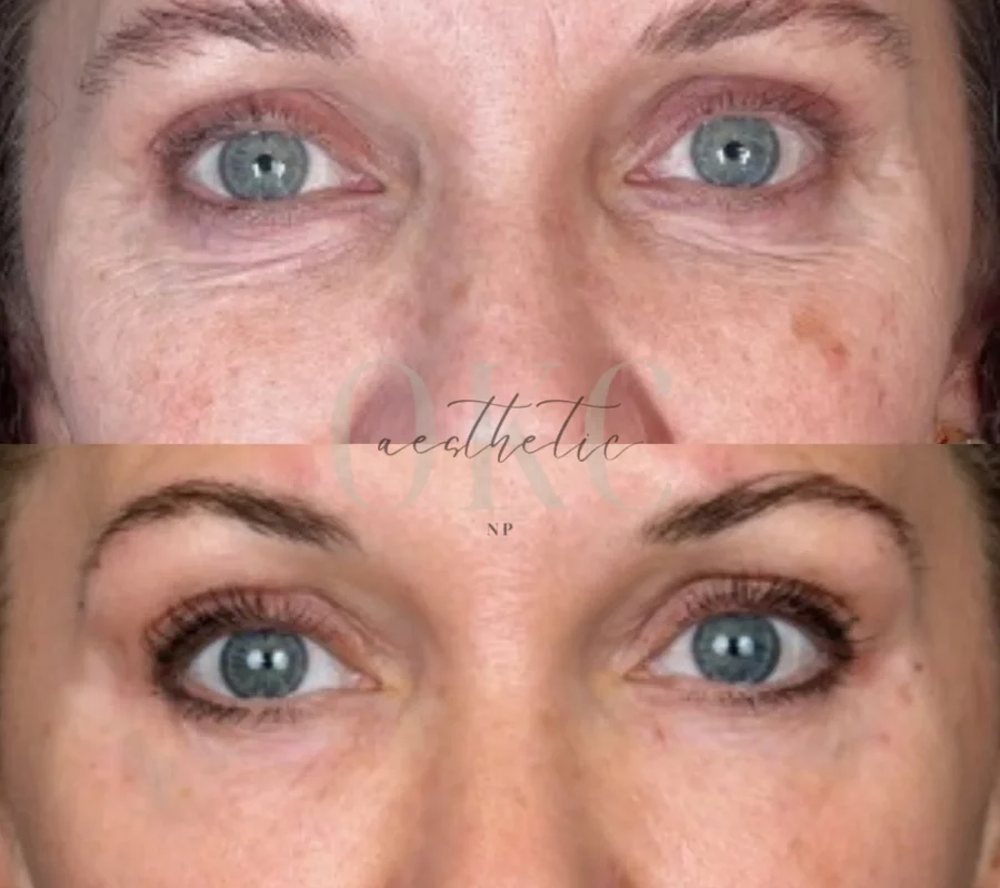 Under-Eye Treatment Before and After Images - 14 Regenerative Undereye Therapy lou lou medspa