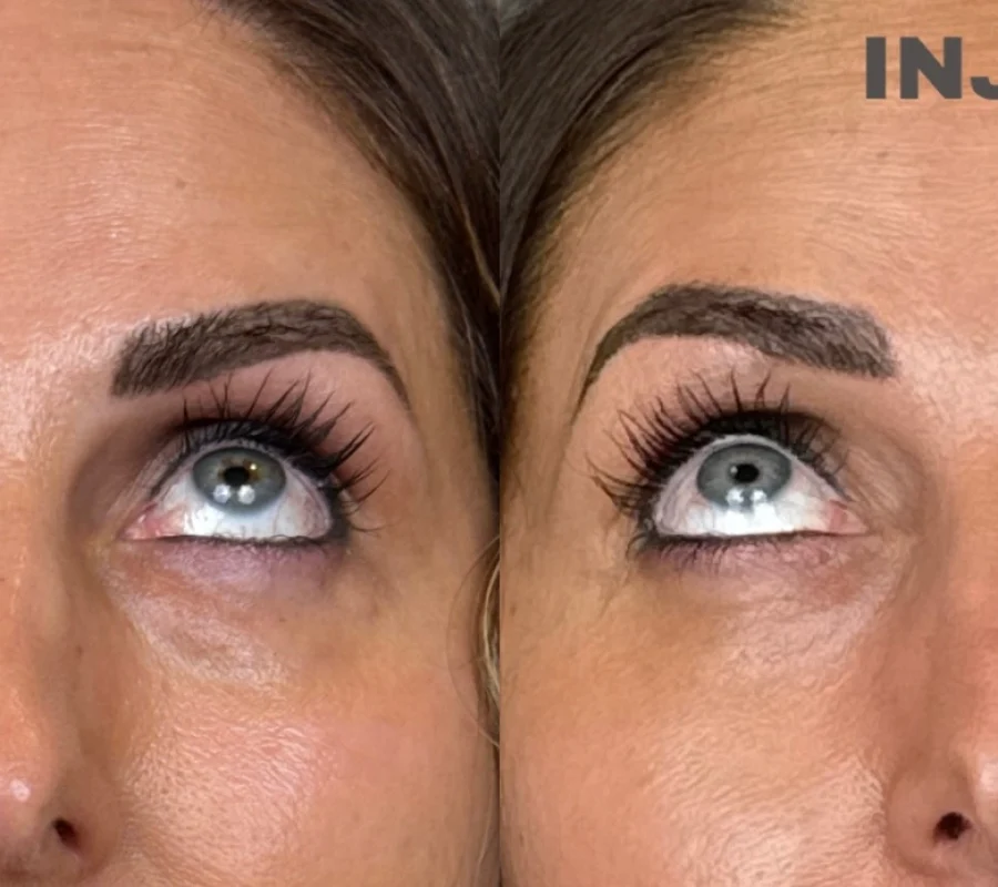Under-Eye Treatment Before and After Images - 2 Under-Eye Treatment Before and After Images a